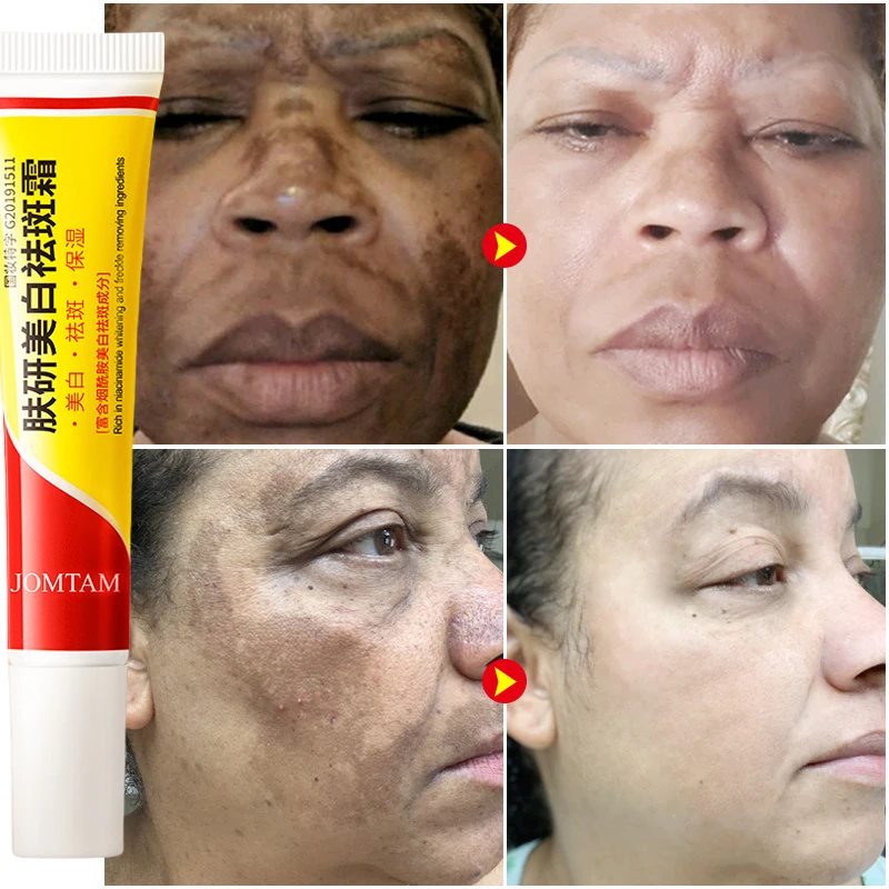 Whitening Freckle Cream Face B - Skincare Glad2Glow recensione e prezzo